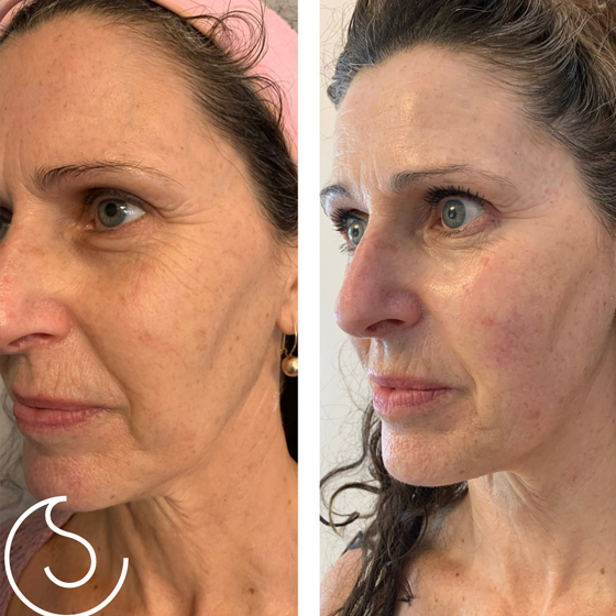4D Hifu & Laser ( Non Surgical makeovers)