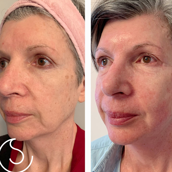 4D Hifu & Laser ( Non Surgical makeovers)